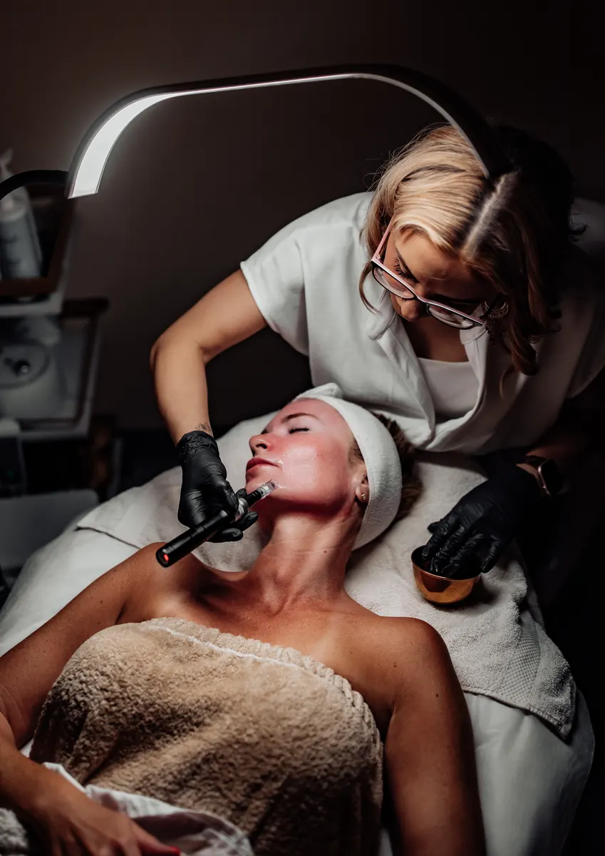 Professional microneedling treatment along a new client's jawline in Tucson
