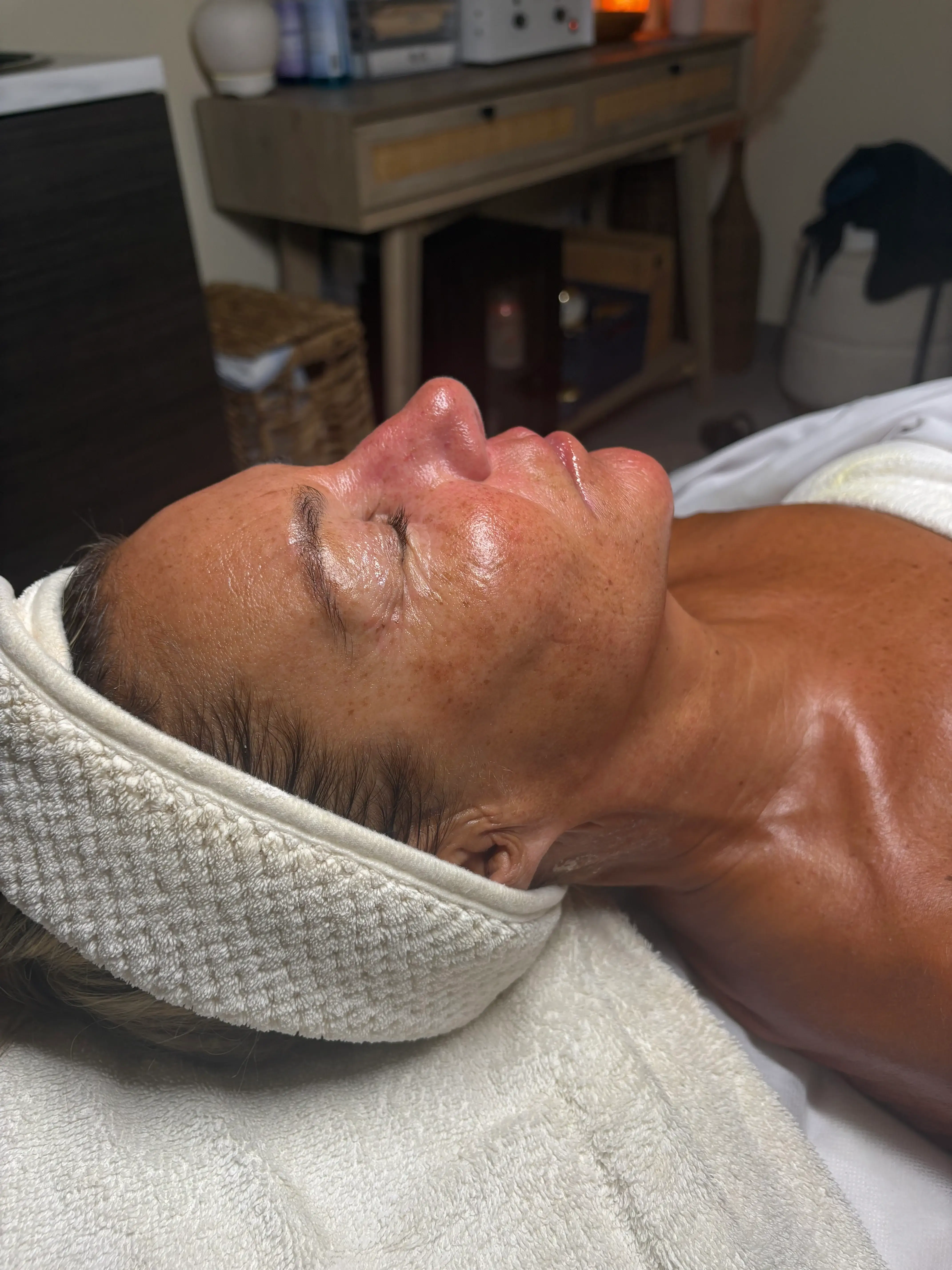 15% TCA Chemical Peel featured image