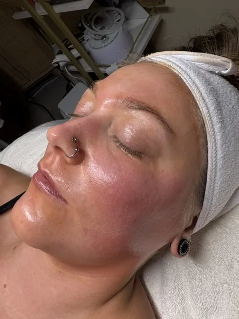Client immediately after a 15% TCA chemical peel in Tucson, Arizona