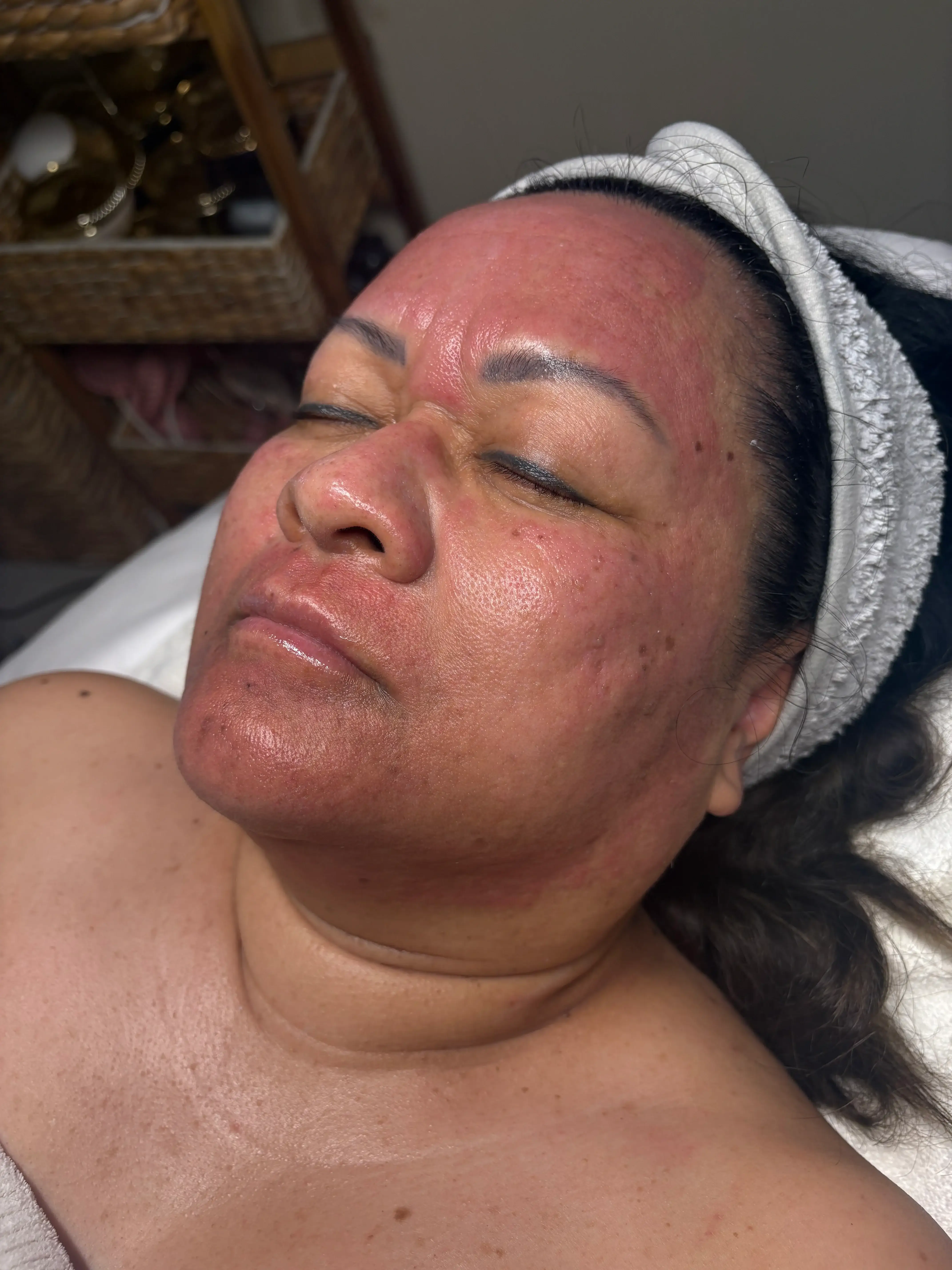 5 Berry Pigment Peel featured image