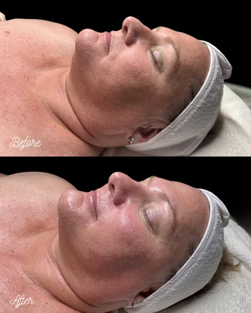 Before and immediately after a Custom Luminous Facial in Tucson